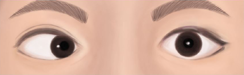 Strabismus