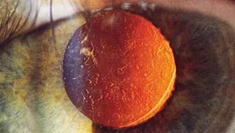 Posterior Capsular Opacification