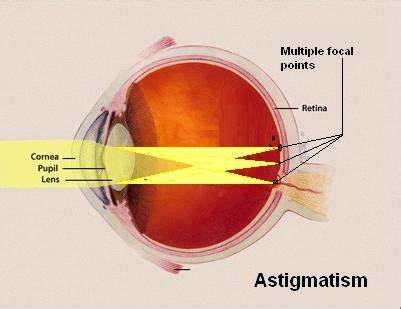 Astigmatism