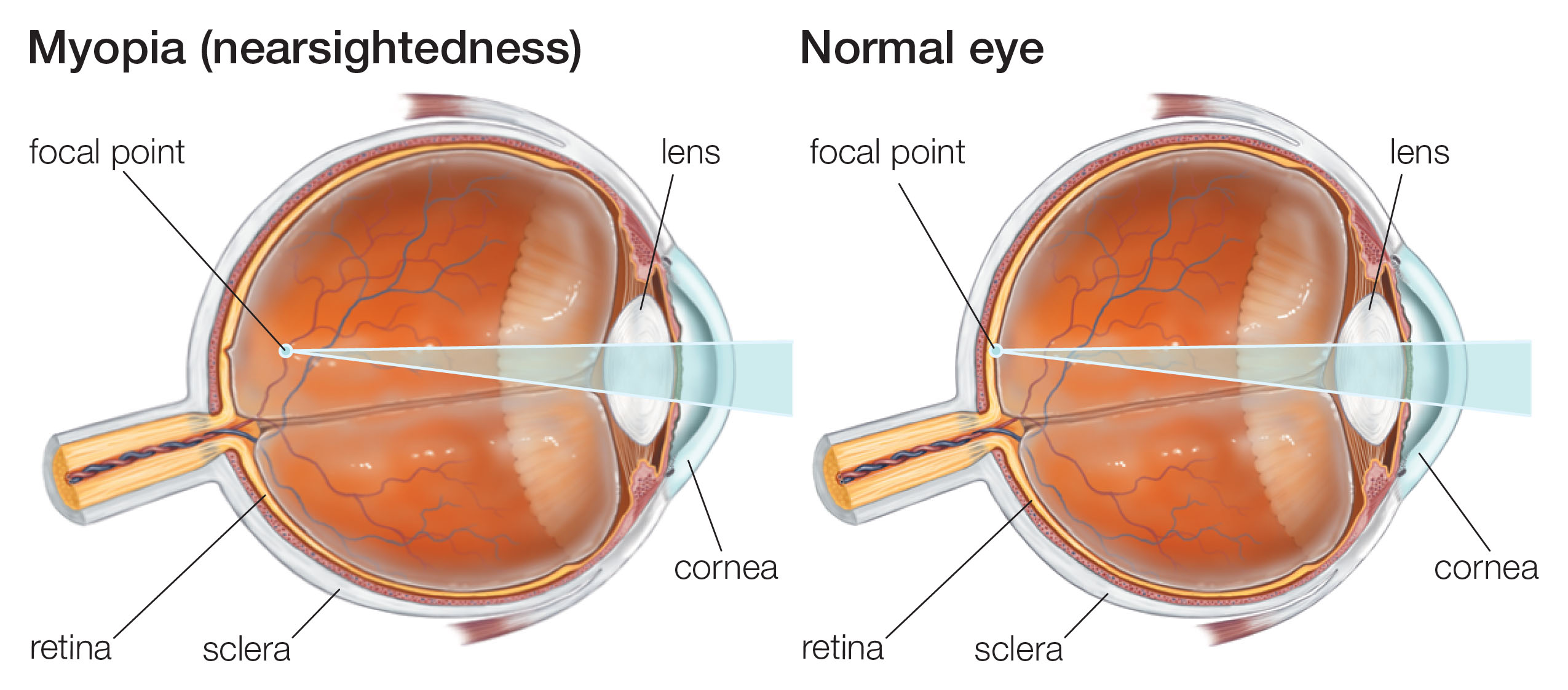 myopia eye diagram)