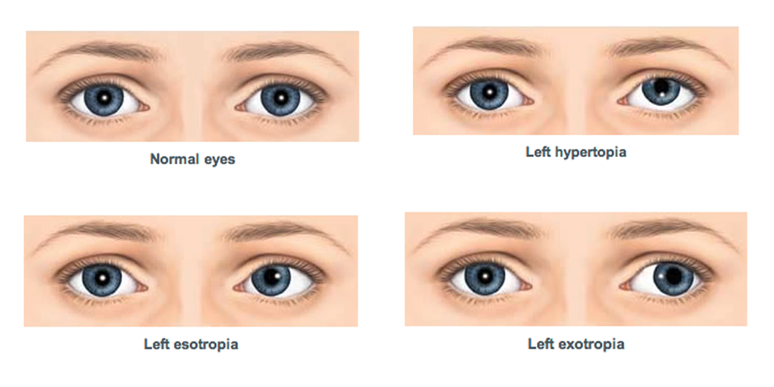 Strabismus