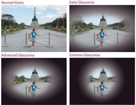 Glaucoma Field Loss