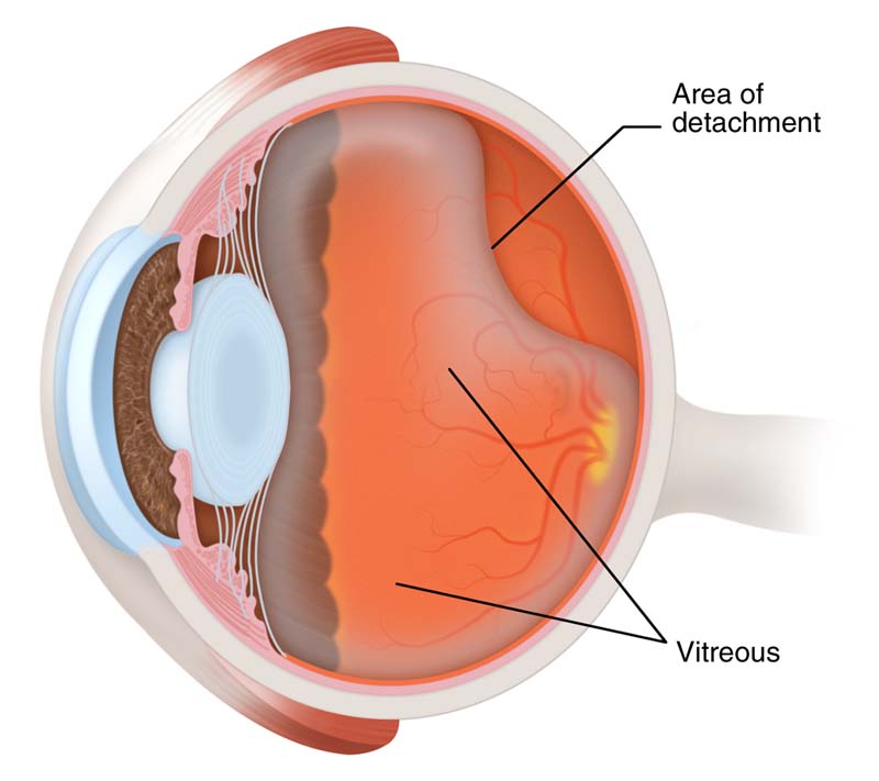 Vitreous Detachment